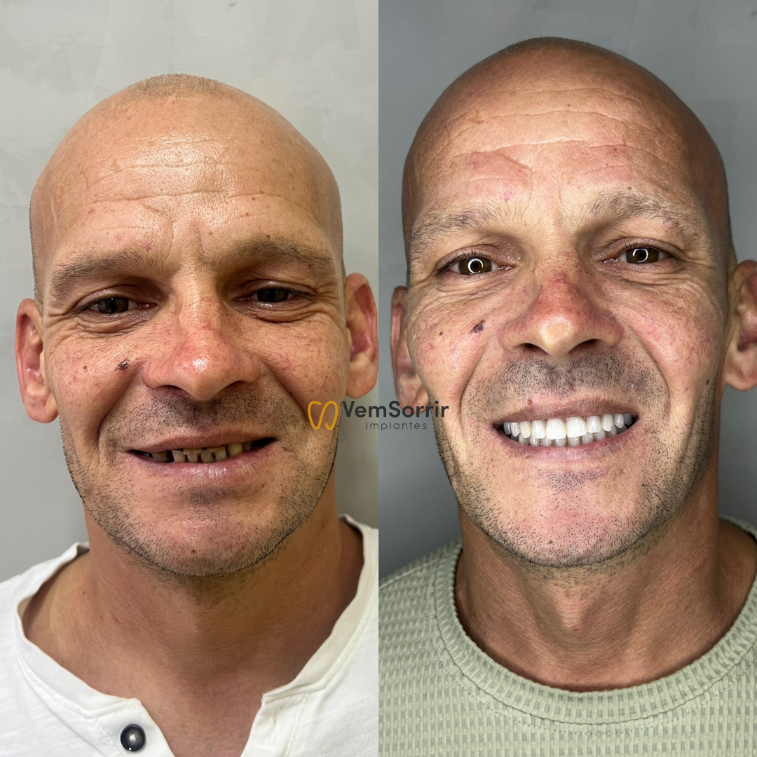 Resultado de Implante 1