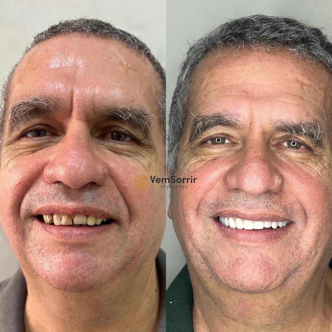 Resultado de Implante 2